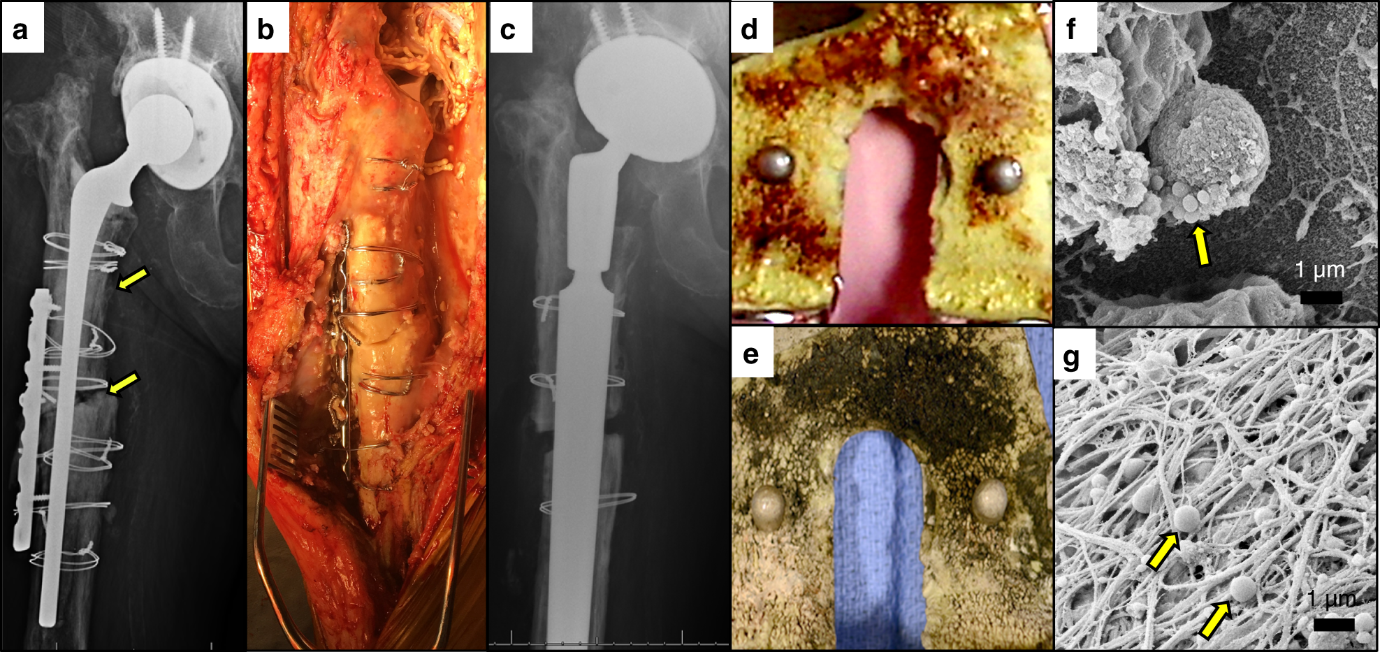 Evolving Concepts In Bone Infection Redefining Biofilm Acute