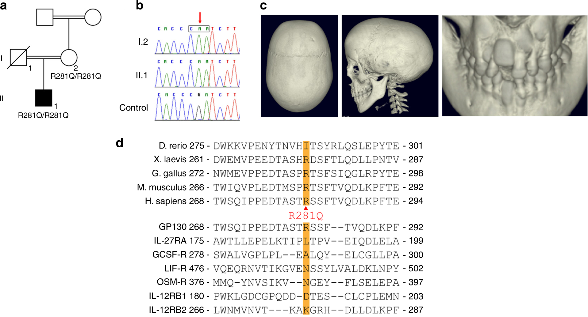 A Variant In Il6st With A Selective Il 11 Signaling Defect In Human And Mouse Bone Research