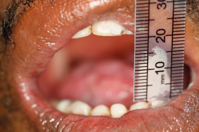 Clinical measurement of mouth opening