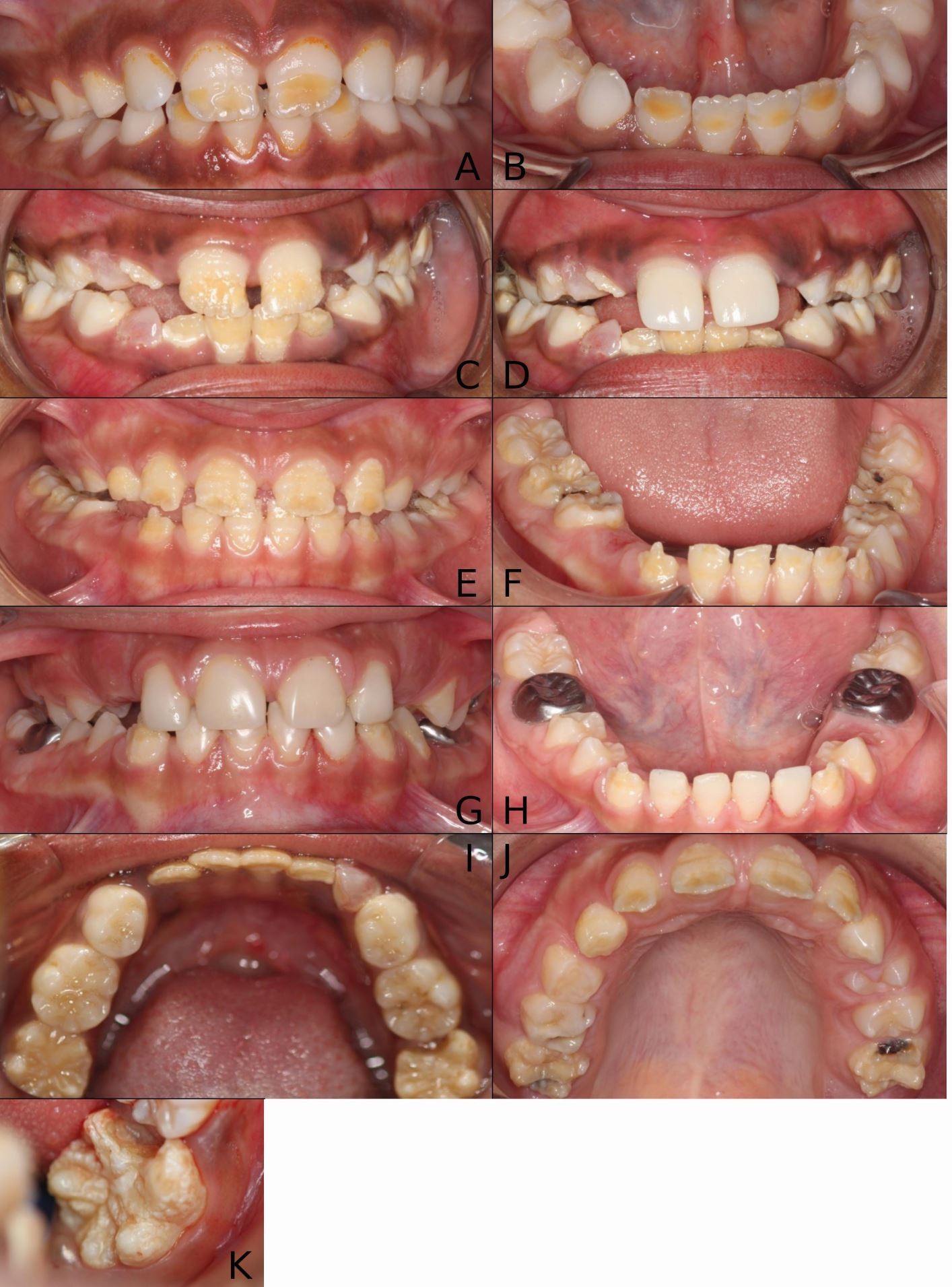 Oral manifestations of vitamin D deficiency in children | British Dental  Journal