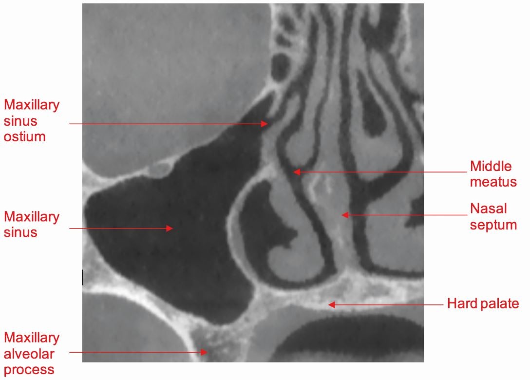 Challenges in plain film radiographic diagnosis for the dental team: a  review of the maxillary sinus | British Dental Journal, image size:1088x780