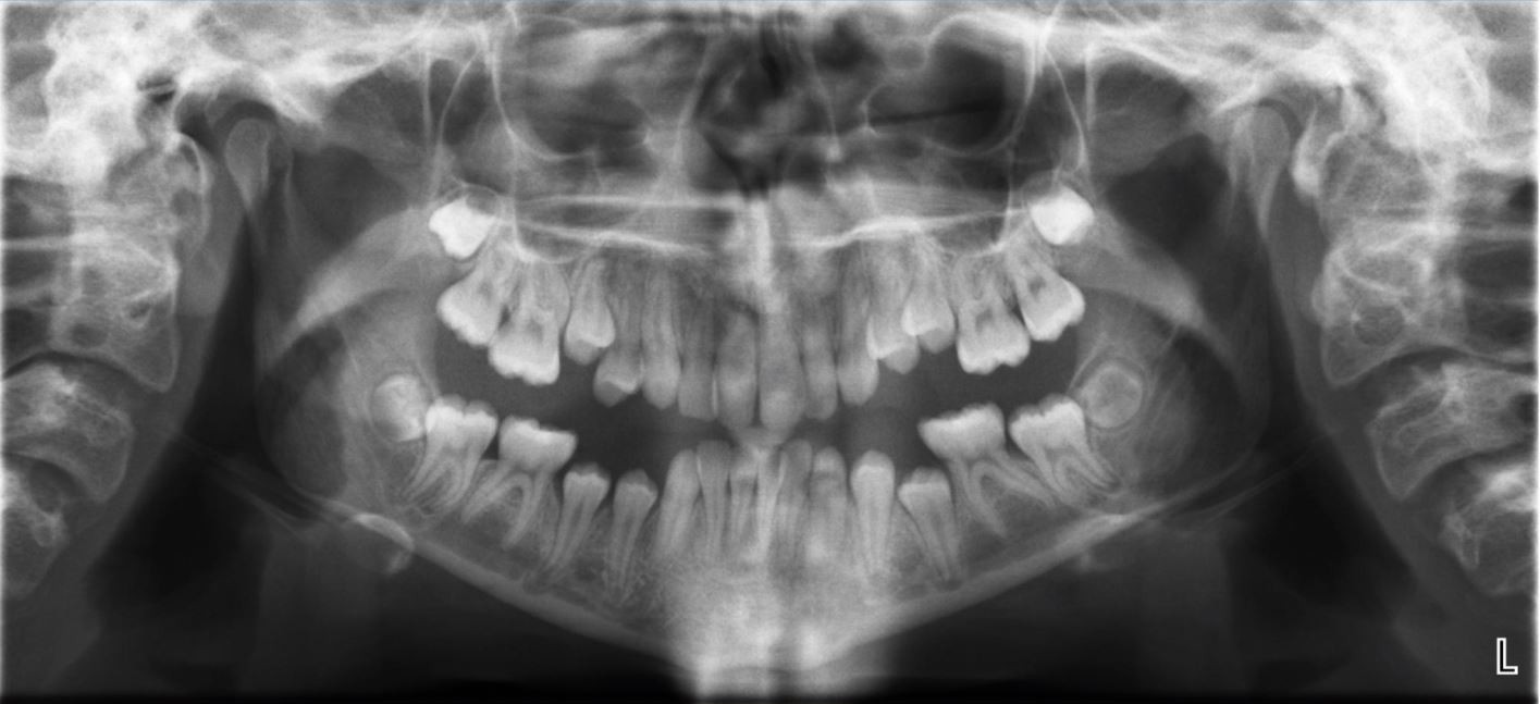 Orthodontic Related Nerve Injuries A Review And Case Series British Dental Journal