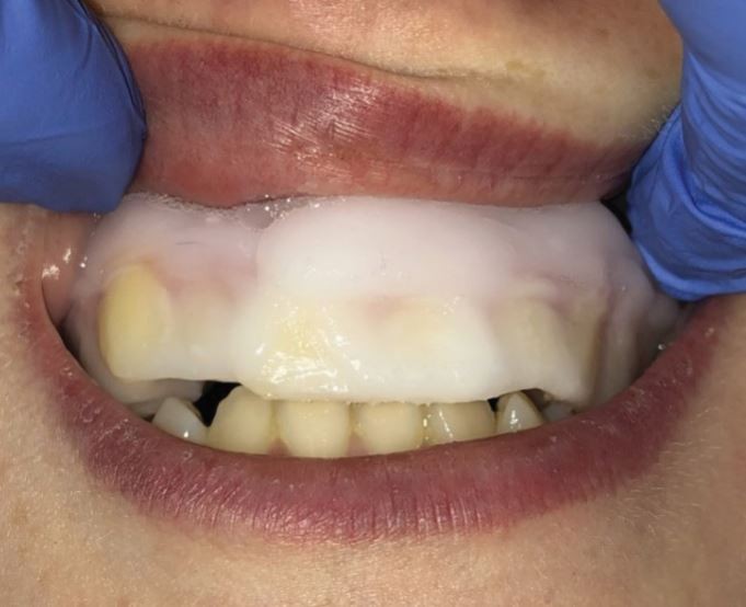 TikTok vampire fangs  British Dental Journal