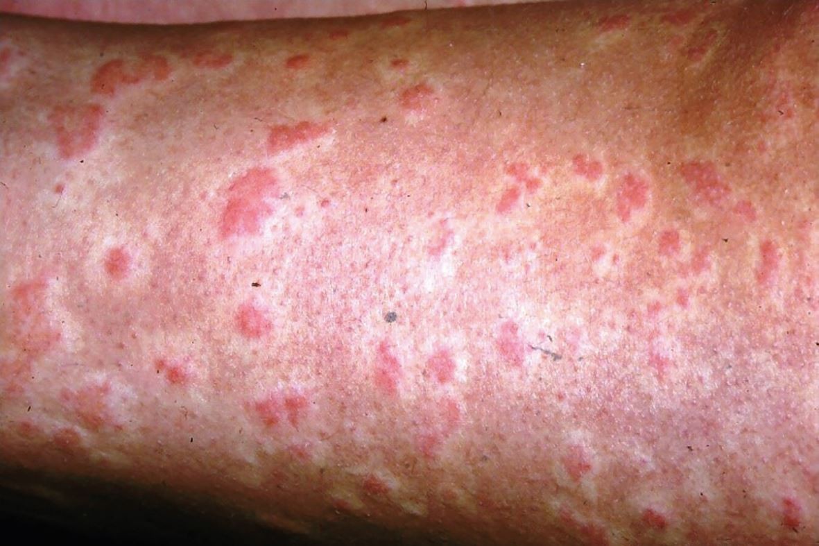 Management Of Anaphylaxis In The Dental Practice An Update British Dental Journal