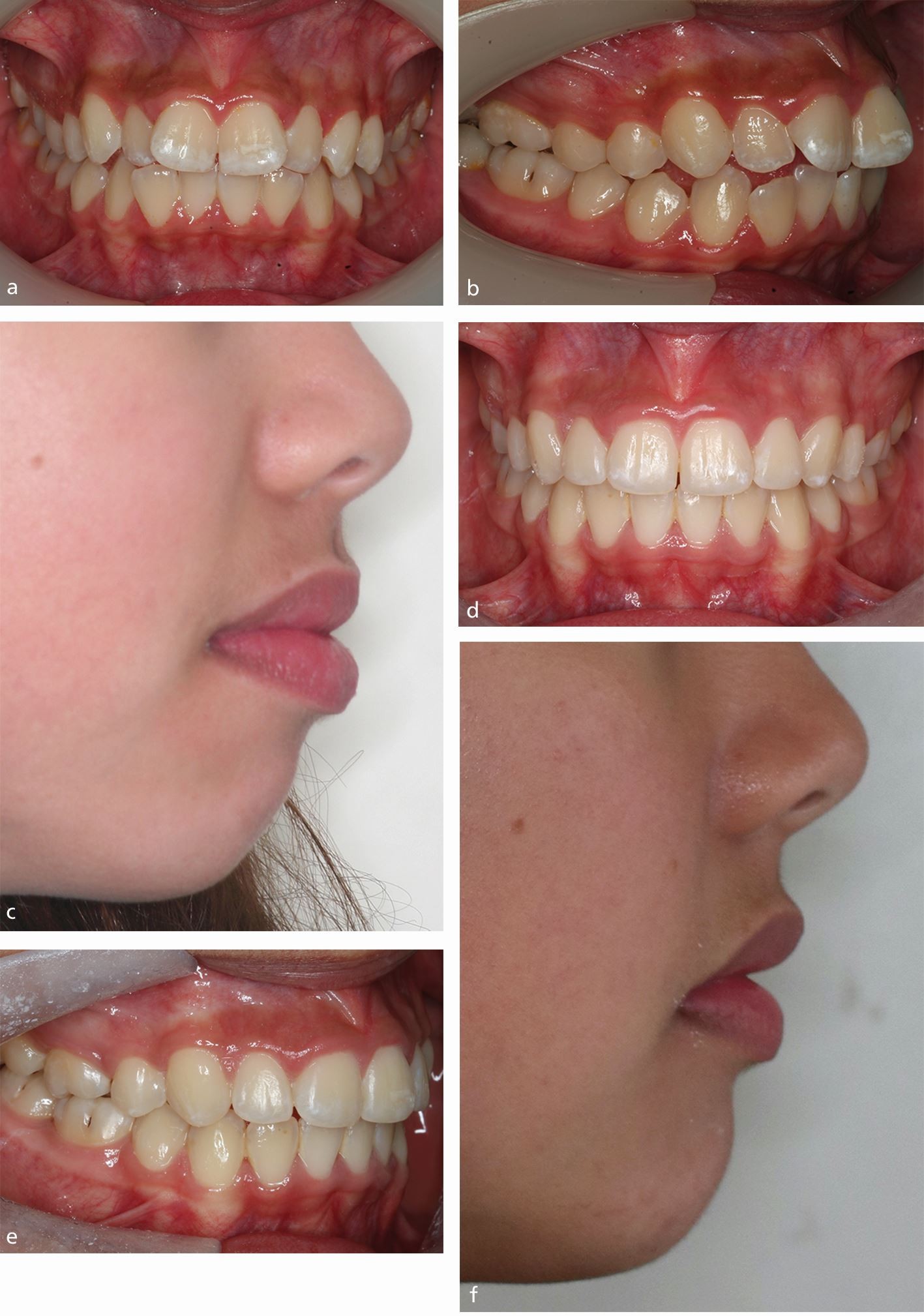 Stability of a severe Class II malocclusion correction in a