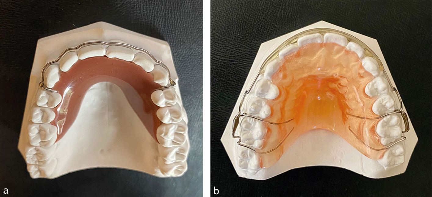 Removable orthodontic retainers: practical considerations | British Dental  Journal
