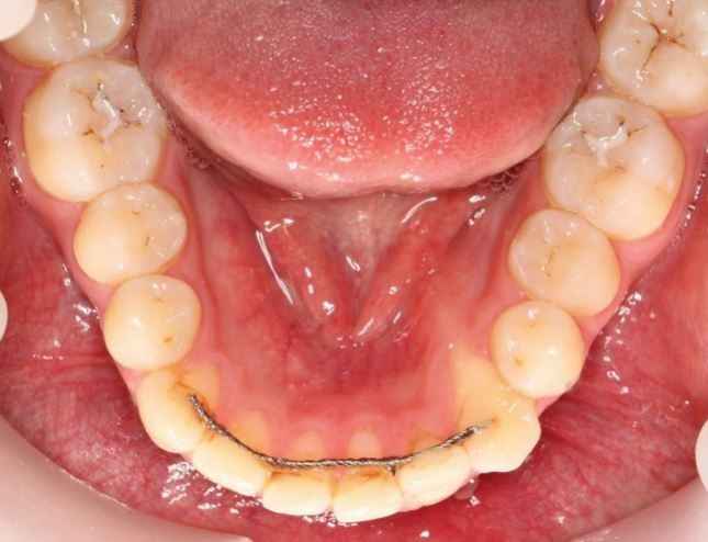 Gingival recession with fixed retainer | British Dental Journal