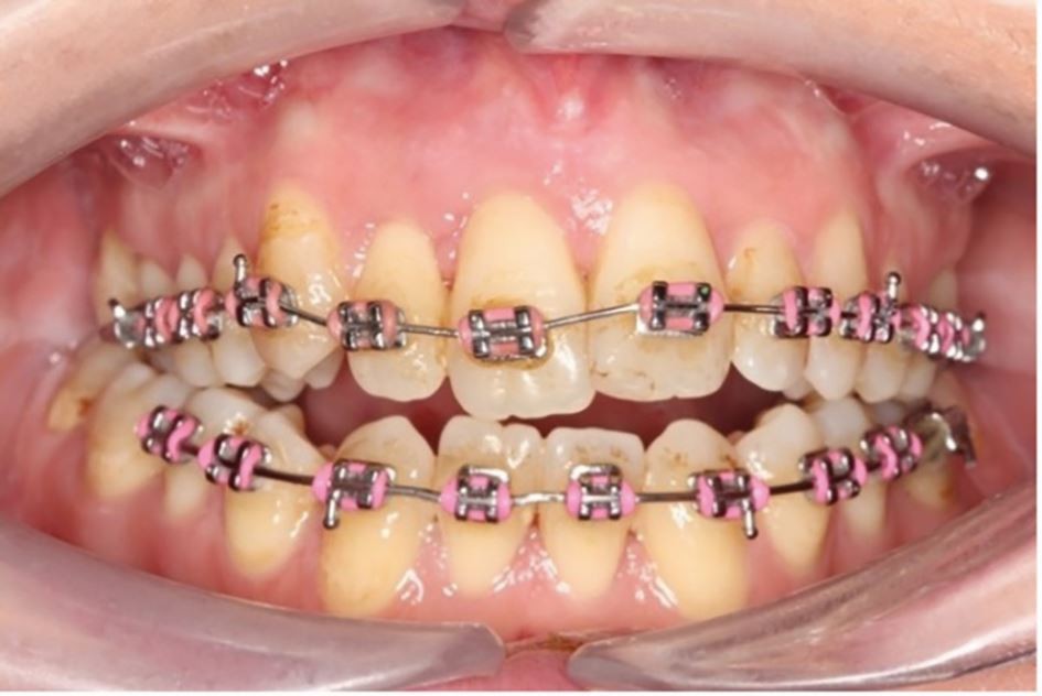 Management of acute traumatic dental injuries in the orthodontic