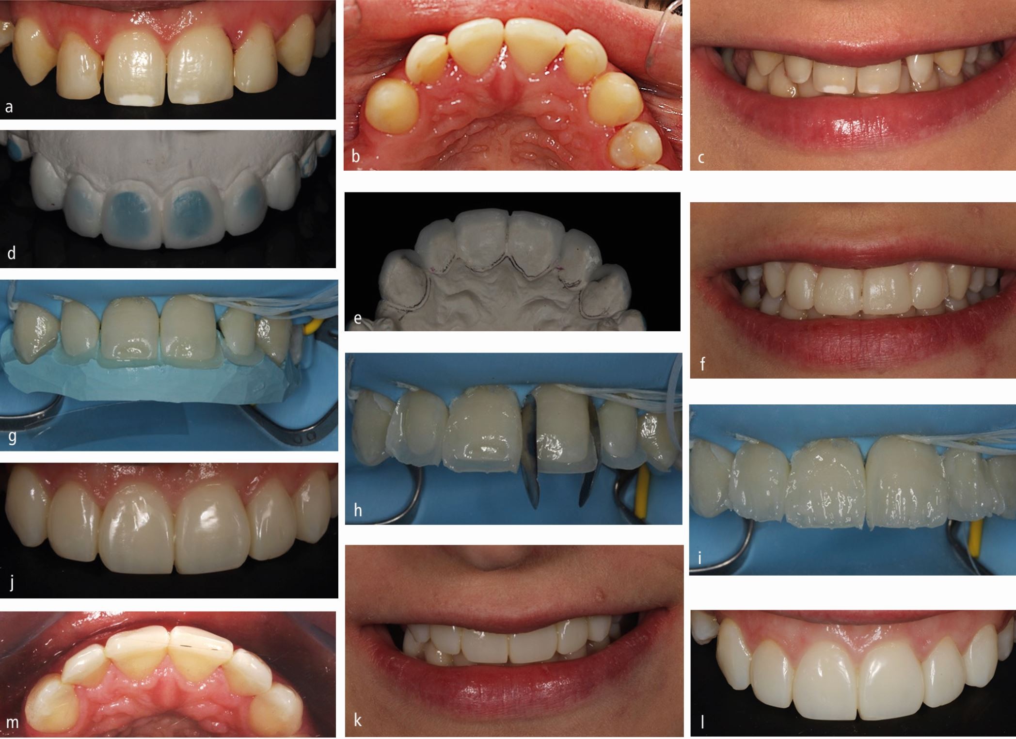 d: After light curing of composite resin over teeth.