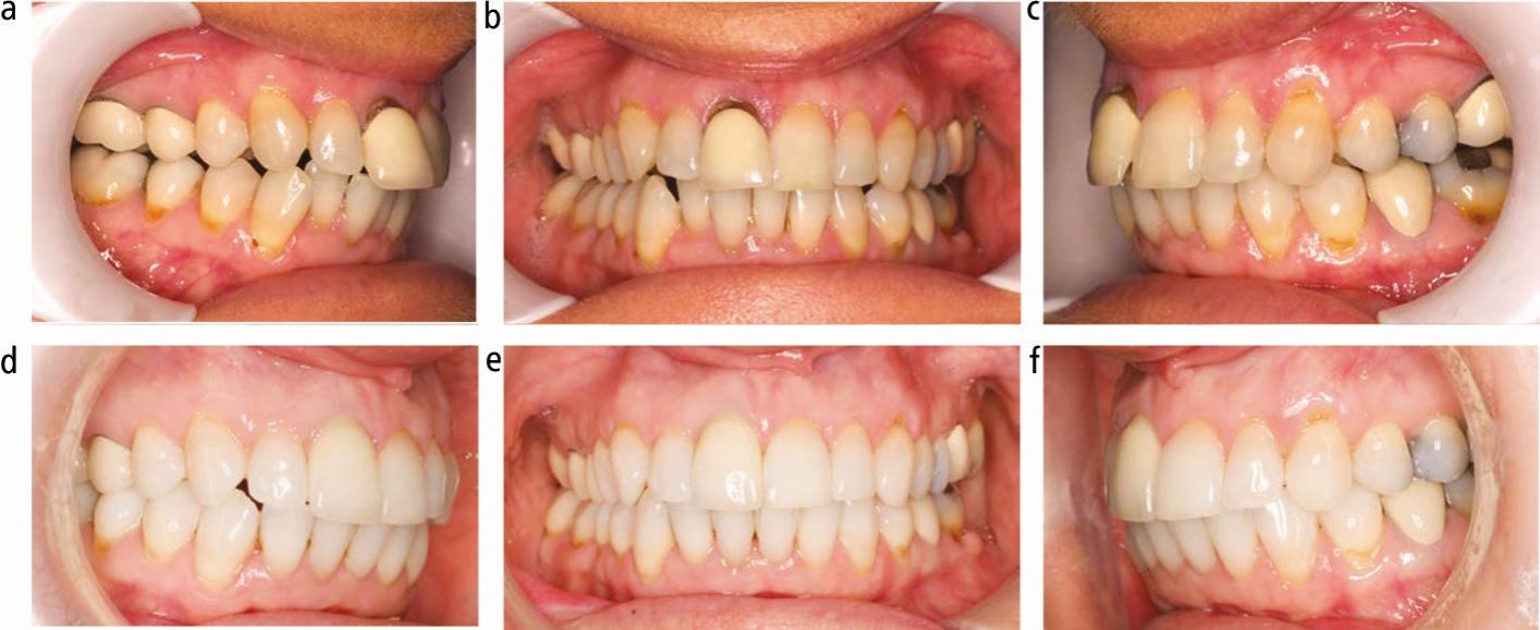 Top 3 Smile-Makeover Combo Strategies