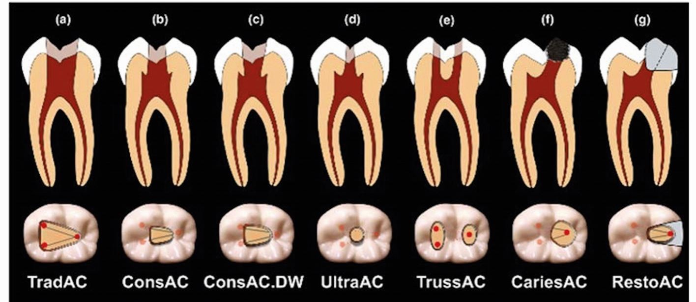Which endodontic access cavity is best? A literature review | British  Dental Journal
