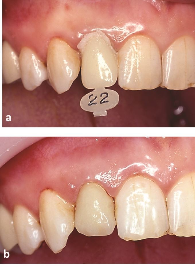 Differences between cad cam and direct provisional crowns
