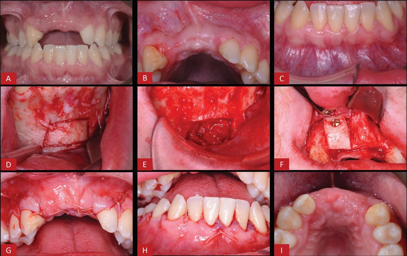 Bone grafting techniques and materials for implant dentistry | British  Dental Journal, image size:1416x891
