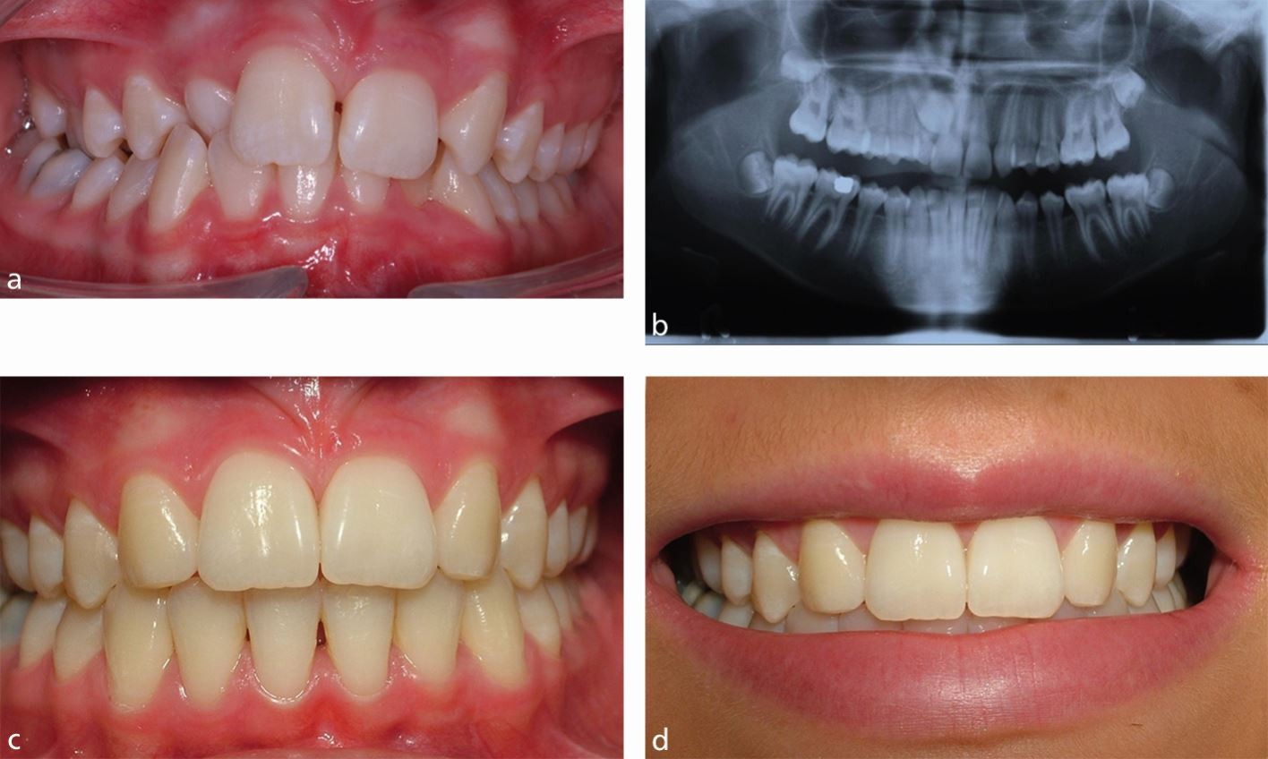 Learn Exactly How I Improved dental replacement In 2 Days