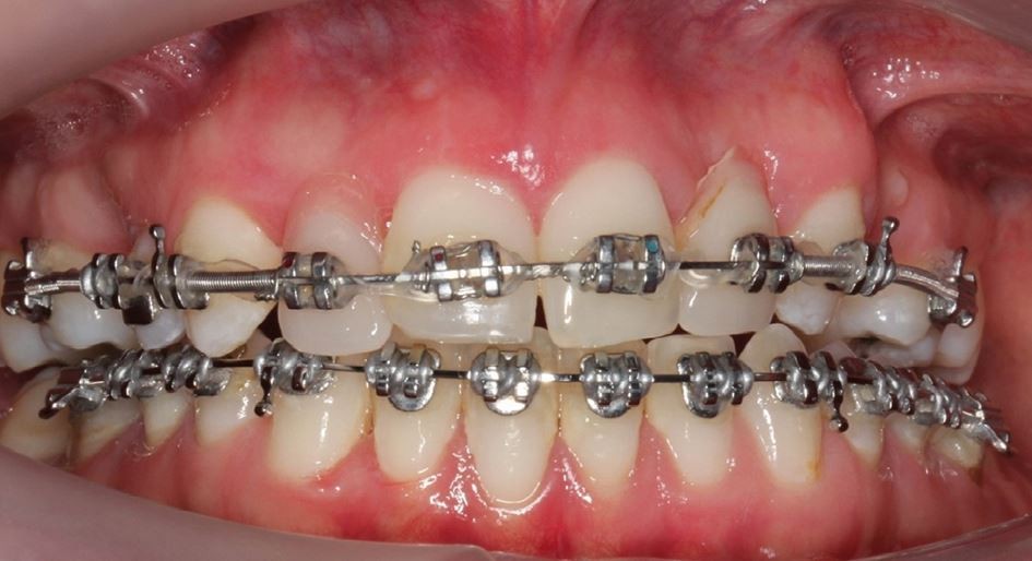 DentaGama on X: Superfloss can clean around braces, implants