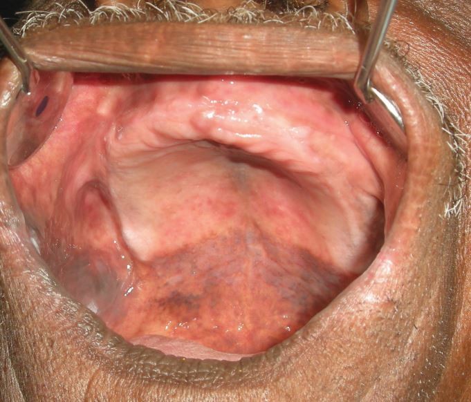 melanotic mucosa Oral Melanotic Macule: Symptoms and Treatment main image 1