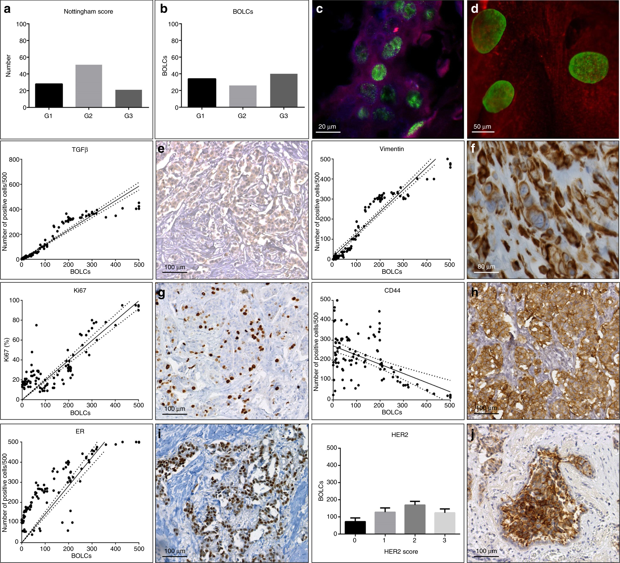 Breast osteoblast-like cells: a new biomarker for the management of breast  cancer | British Journal of Cancer