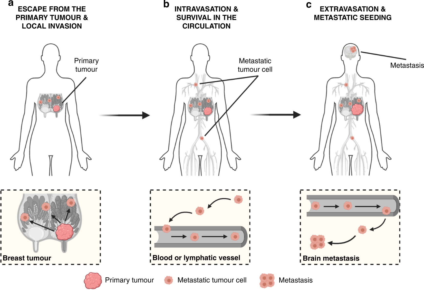 The lingering mysteries of metastatic recurrence in breast cancer