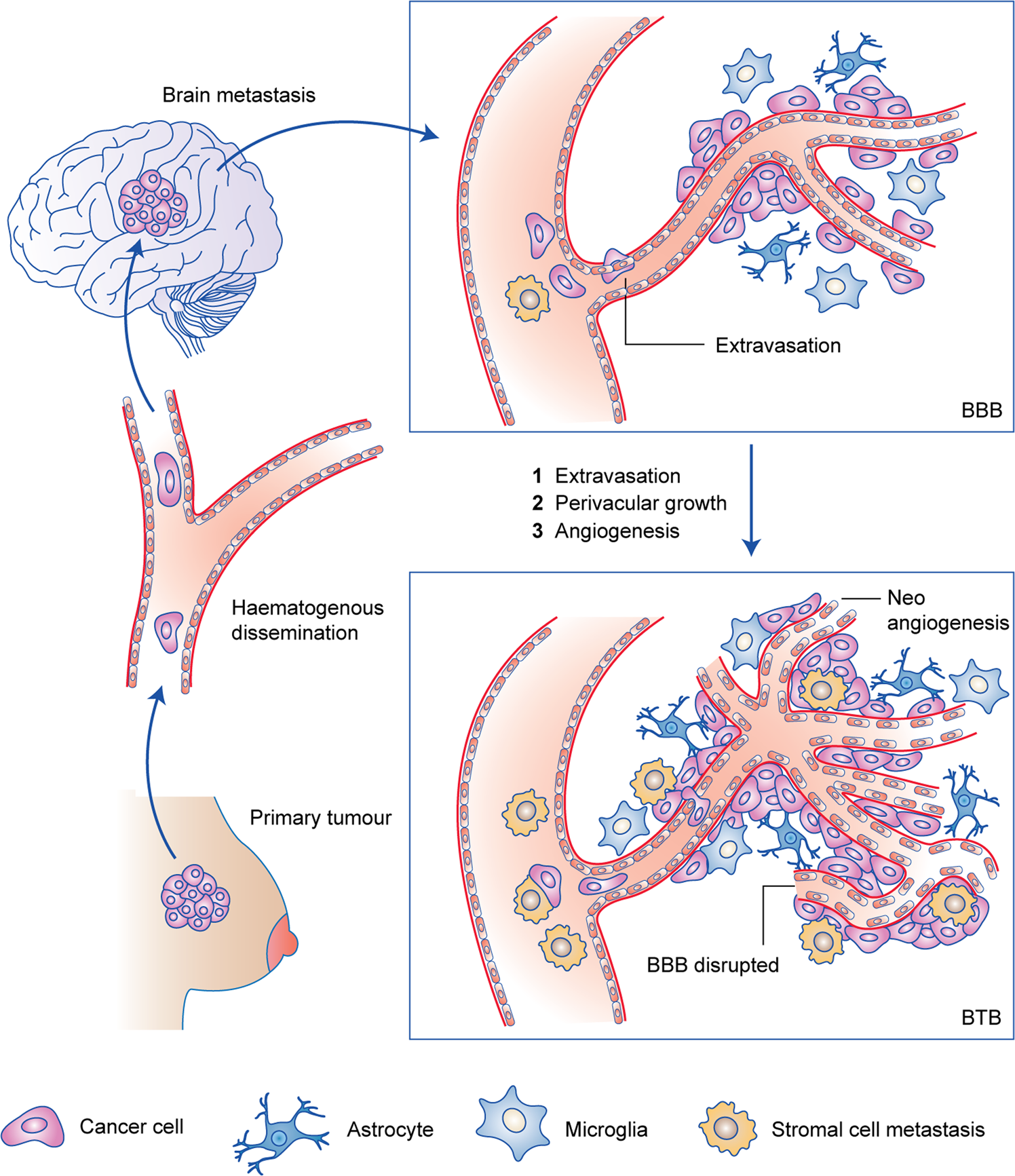 Treatment strategies for breast cancer brain metastases | British Journal  of Cancer