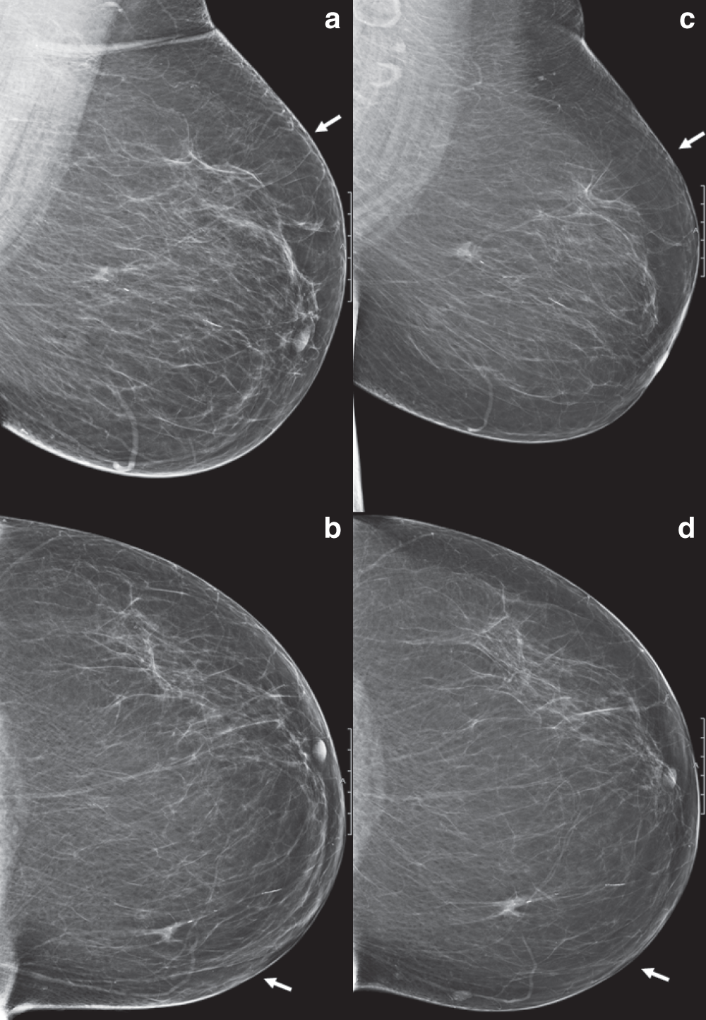 Delayed breast cancer diagnosis after repeated recall at biennial screening  mammography: an observational follow-up study from the Netherlands |  British Journal of Cancer