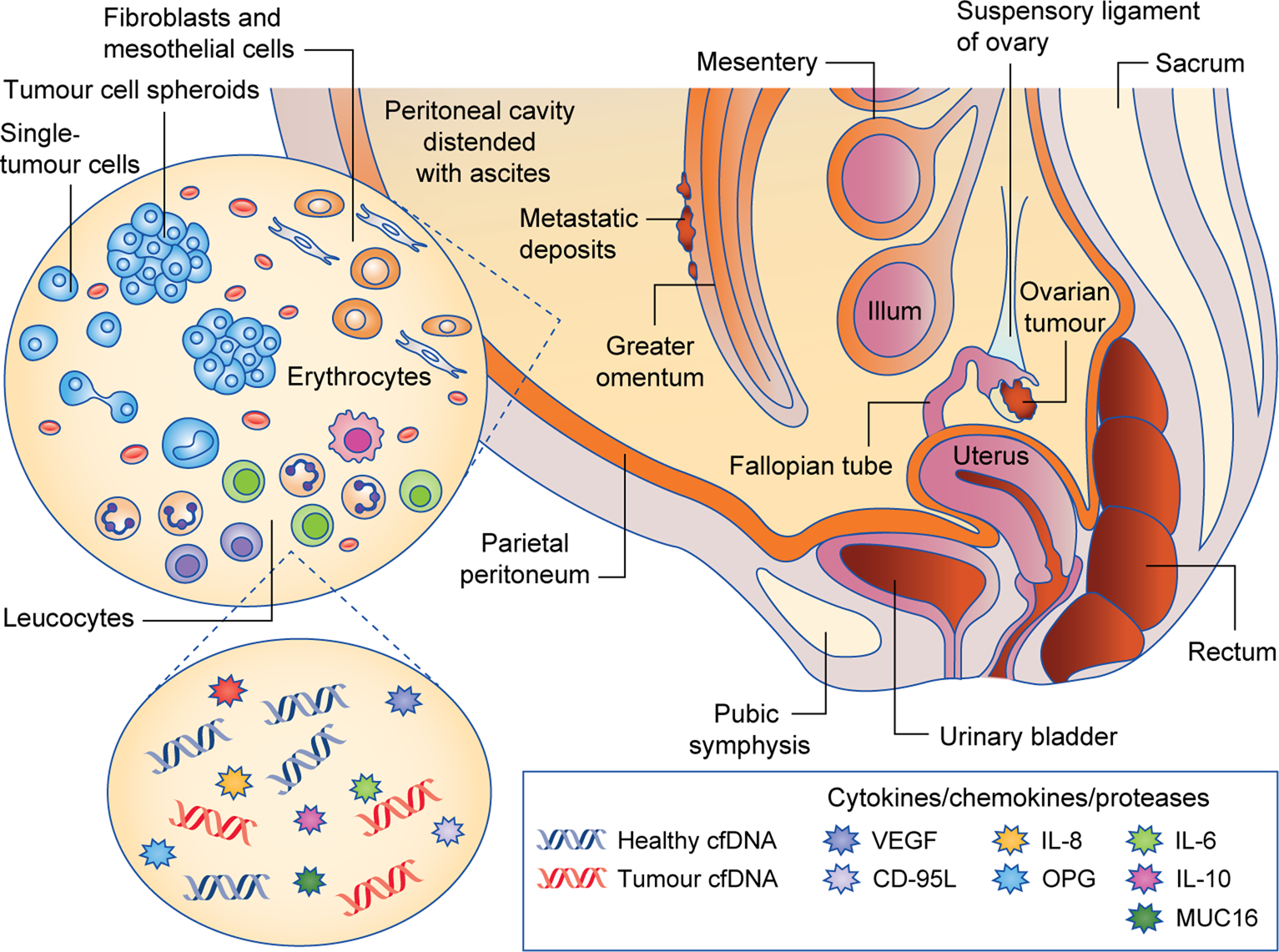 The Untapped Potential Of Ascites In Ovarian Cancer Research And Treatment  | British Journal Of Cancer