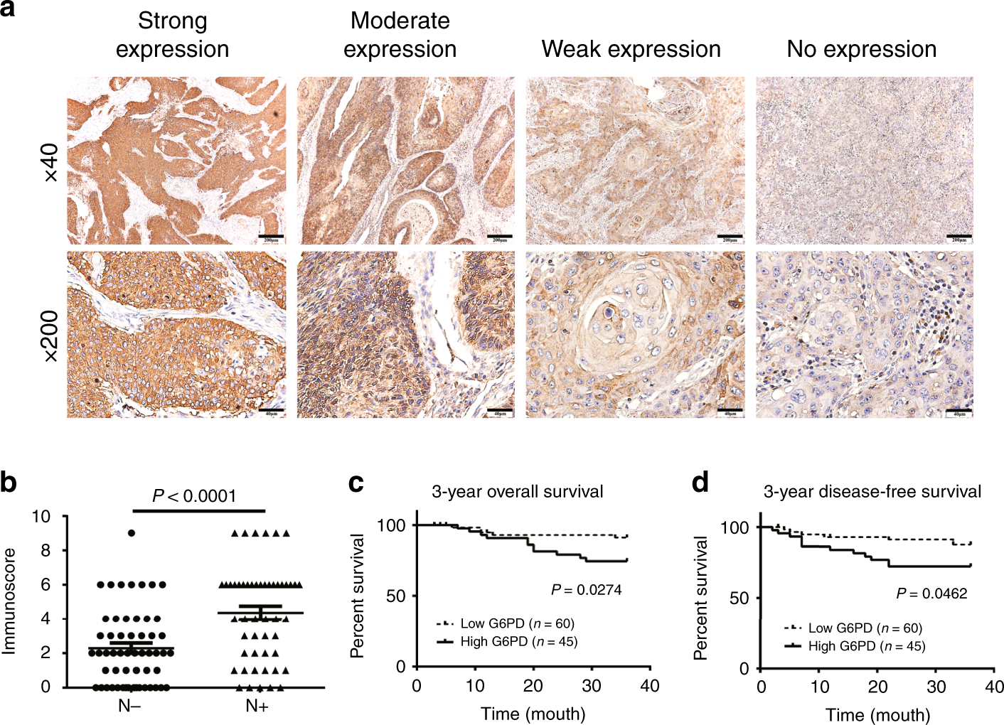 Suppression of G6PD induces the expression and bisecting GlcNAc-branched  N-glycosylation of E-Cadherin to block epithelial-mesenchymal transition  and lymphatic metastasis | British Journal of Cancer