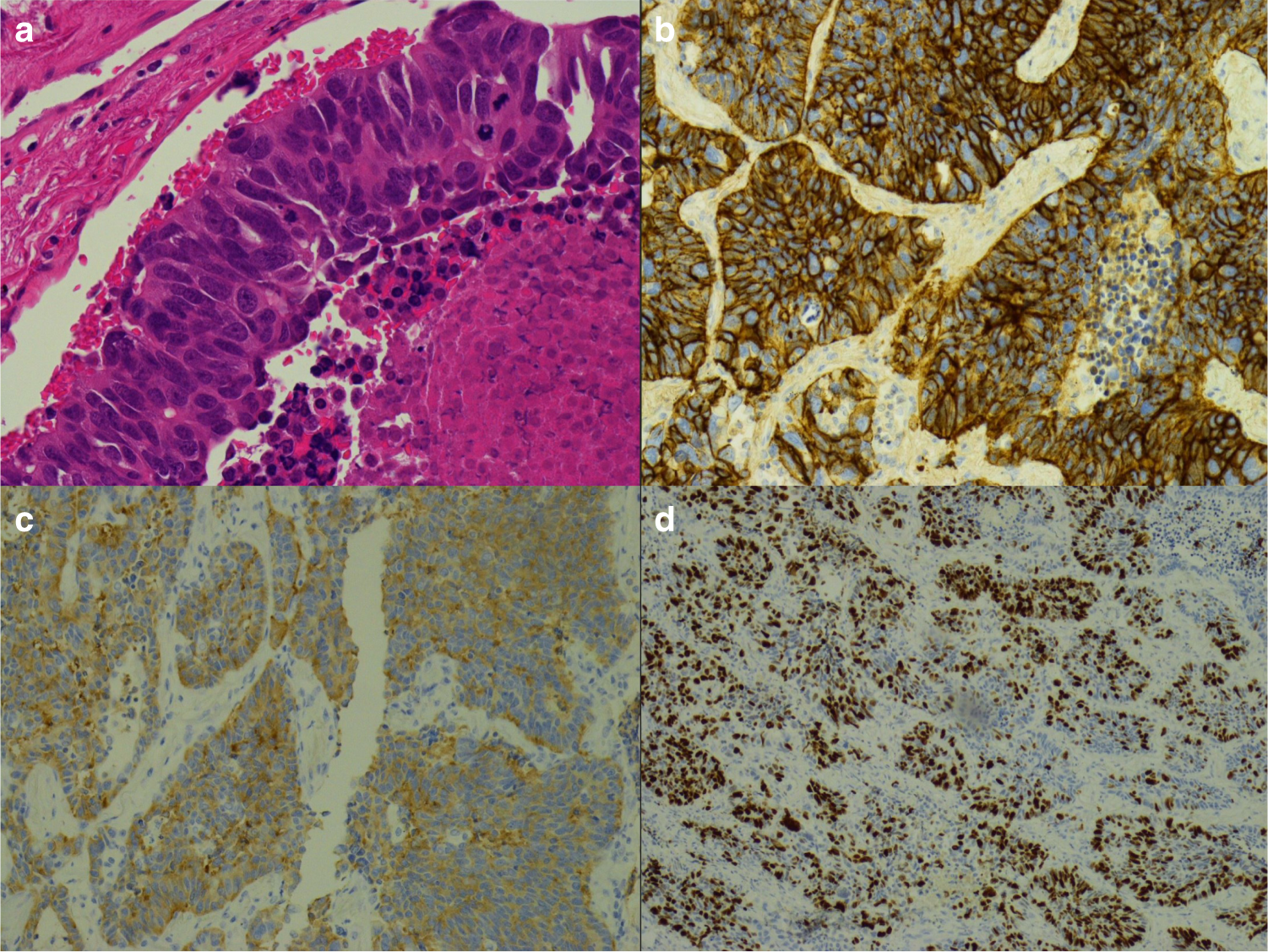 Large cell neuroendocrine lung carcinoma: consensus statement from The  British Thoracic Oncology Group and the Association of Pulmonary  Pathologists | British Journal of Cancer