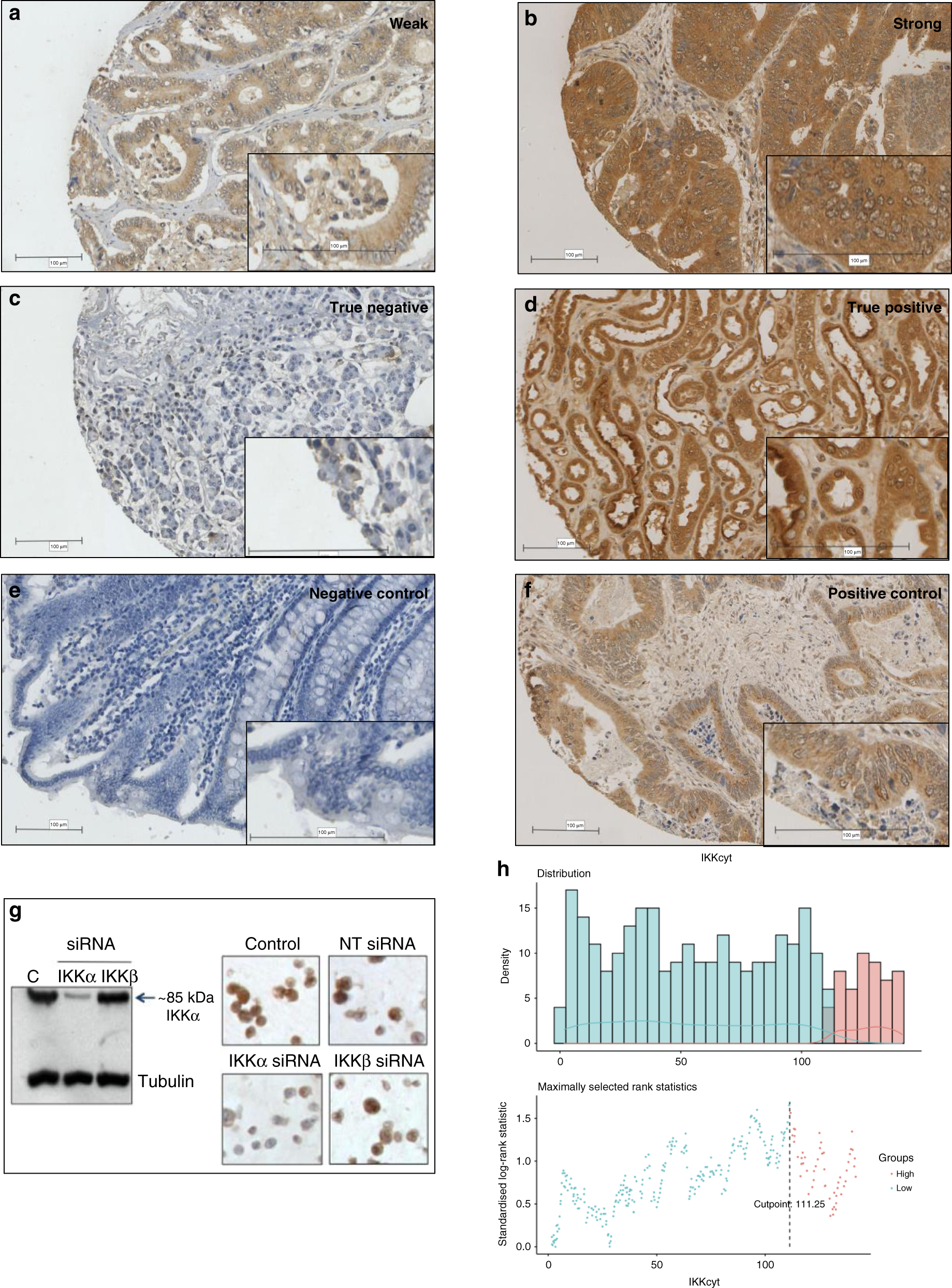 Spatial expression of IKK-alpha is associated with a differential  mutational landscape and survival in primary colorectal cancer | British  Journal of Cancer