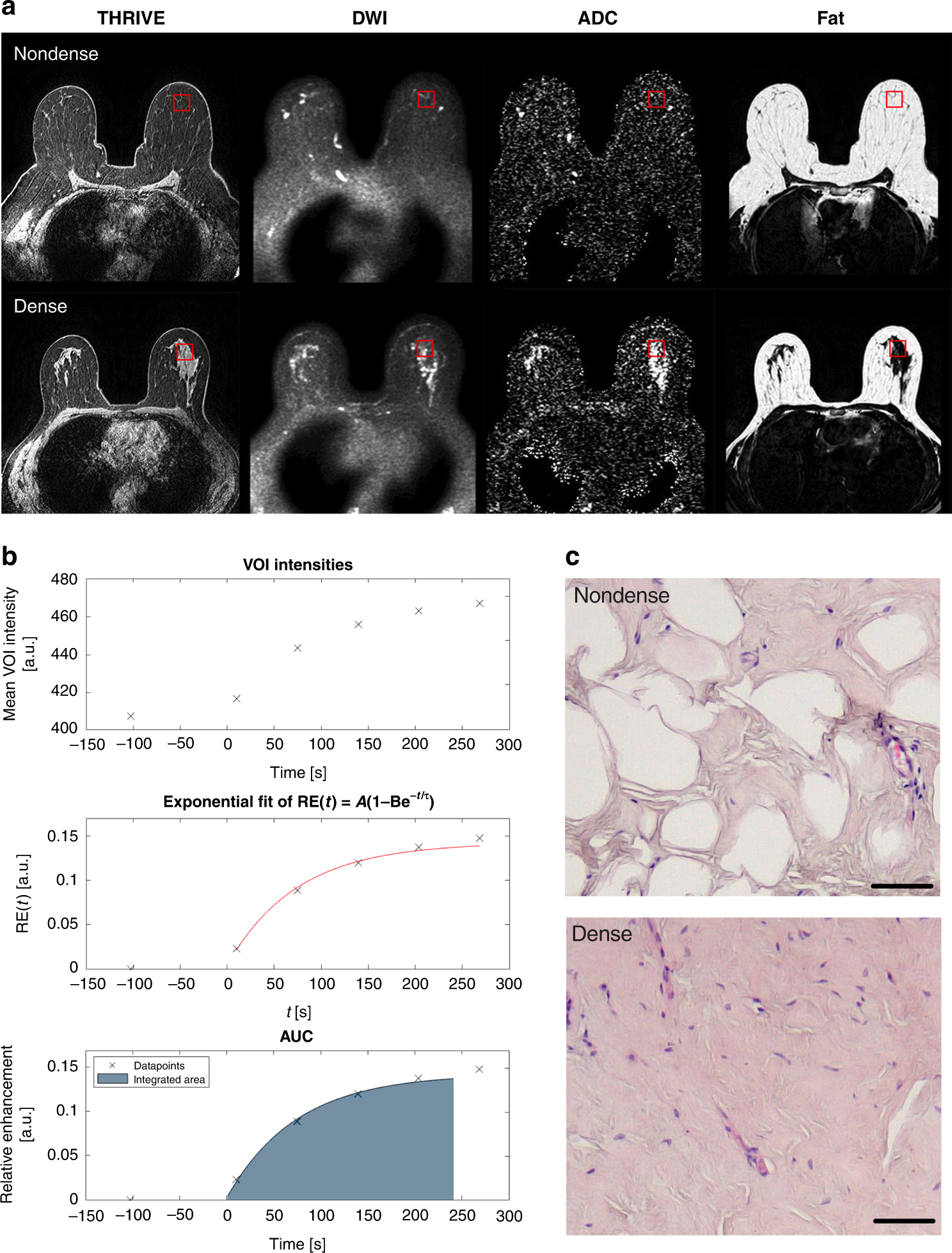 Breast density is strongly associated with multiparametric magnetic  resonance imaging biomarkers and pro-tumorigenic proteins in situ