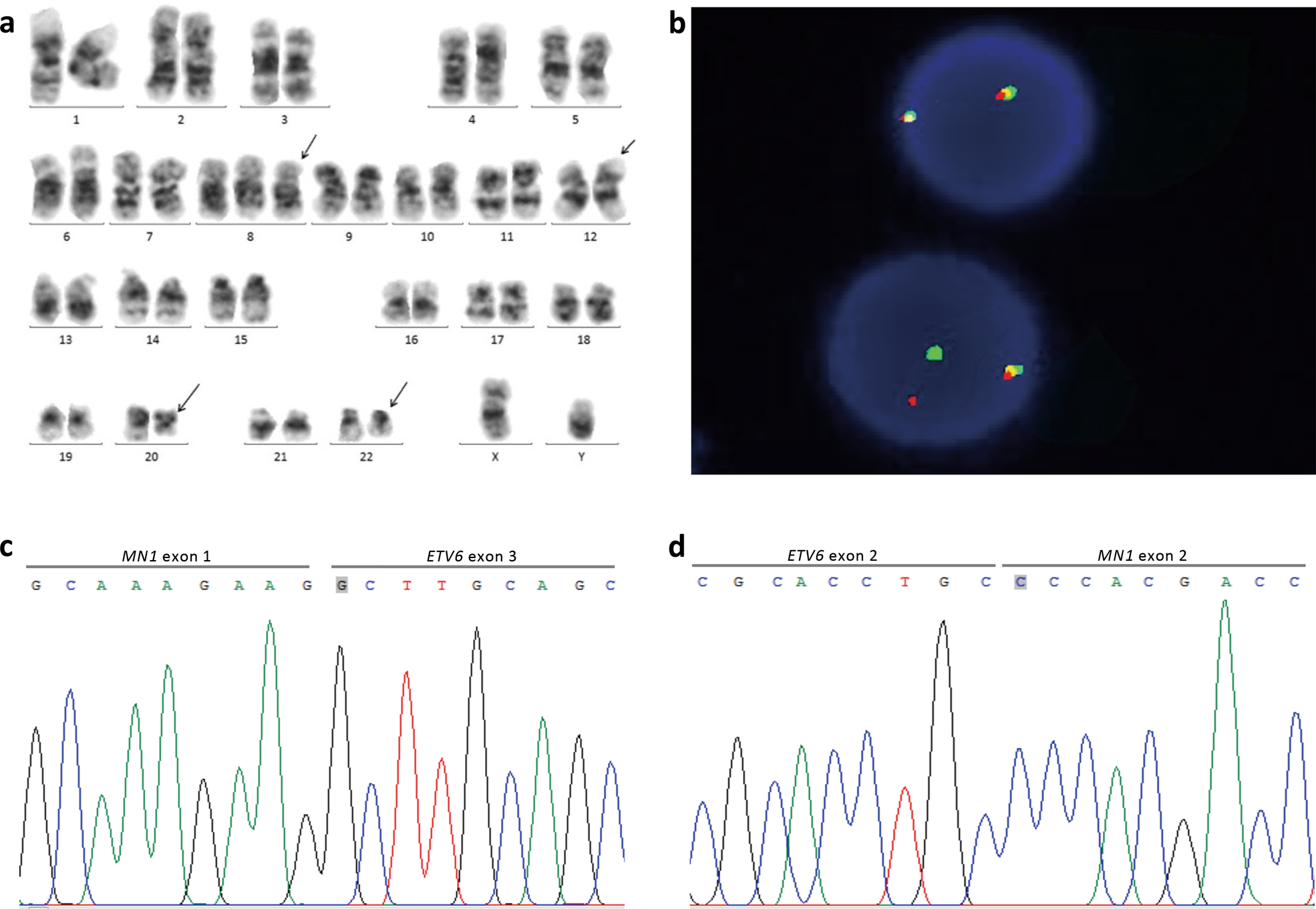 Fig. 2: Karyotype, FISH analysis, and Sanger sequencing of t(12;22)(p13;q12) and MN1-ETV6/ETV6-MN1.