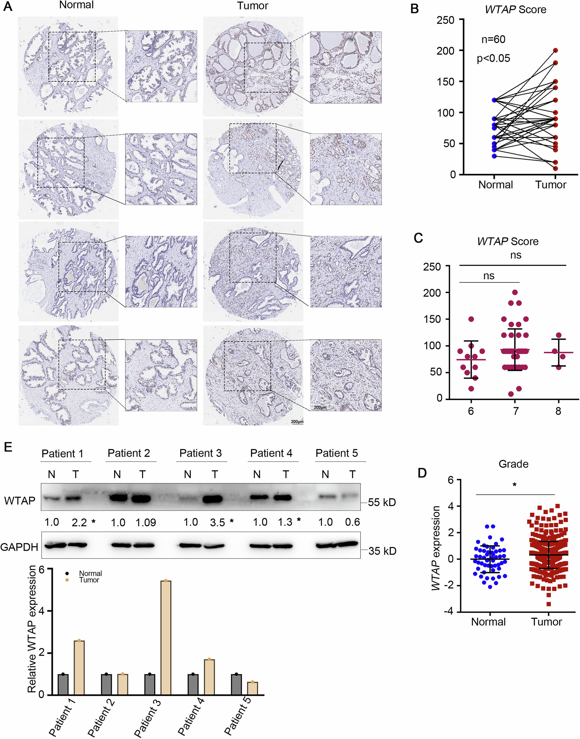 Fig. 1: WTAP is upregulated in PCa tissues.