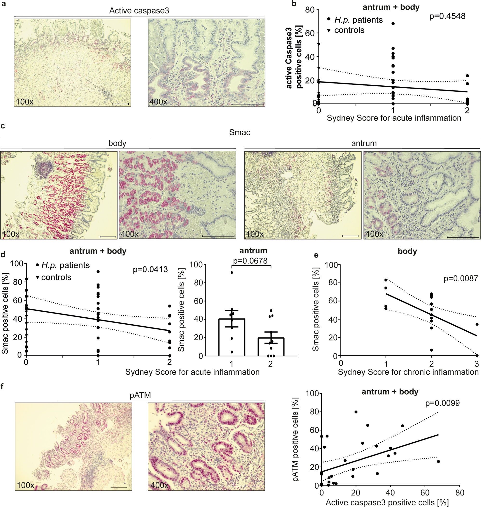Fig. 7: Detection of active caspase-3 and Smac in gastric biopsies from patients infected with H. pylori.