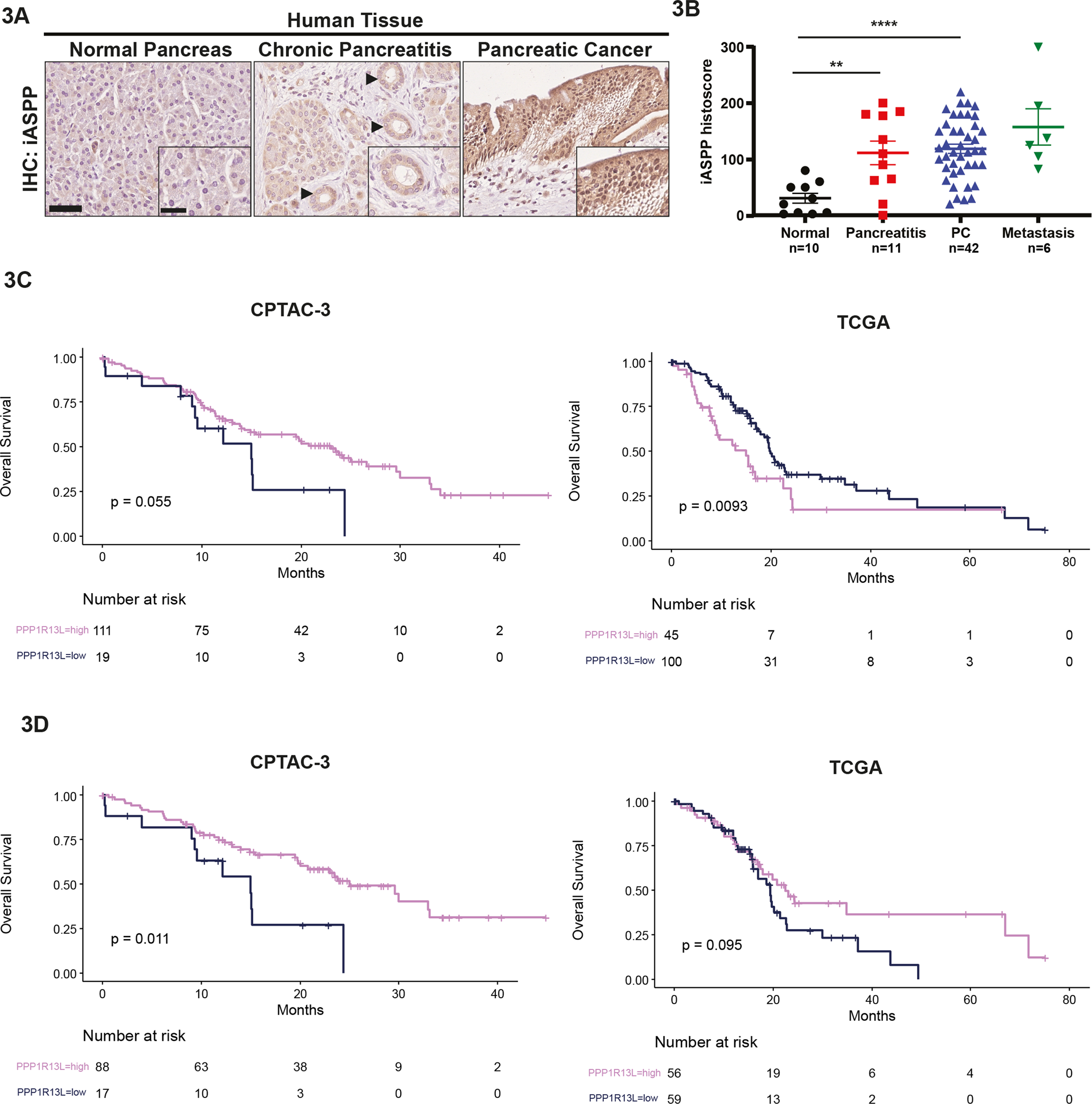 Fig. 3: Inflammation induces iASPP expression in vivo and high iASPP mRNA associates with good prognosis of classical PC.