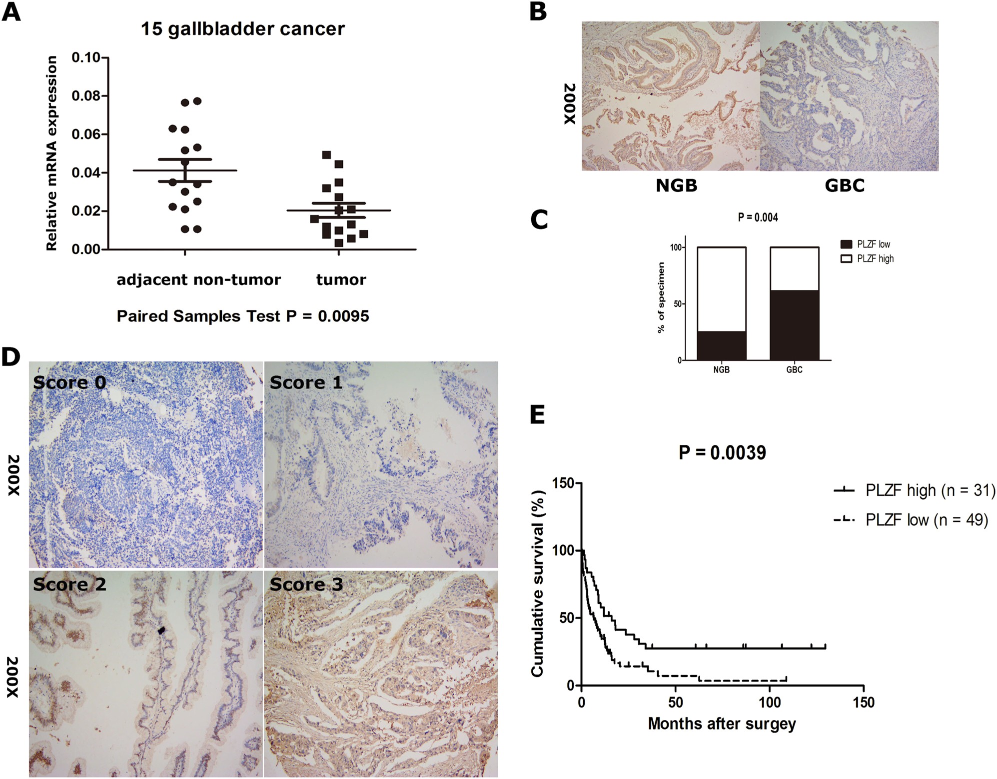 Fig. 1: PLZF was downregulated in GBC and correlated with overall survival