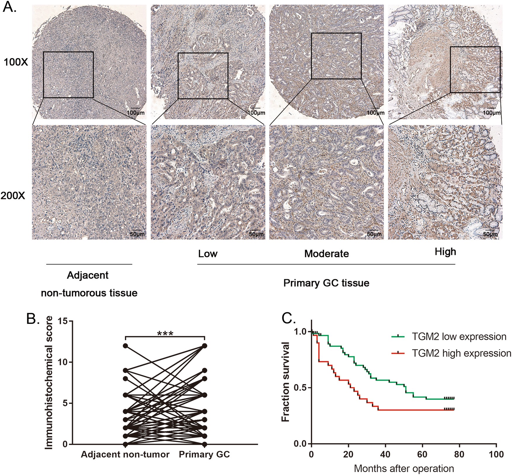 Fig. 4: TGM2 is significantly up-regulated in gastric cancer, and high TGM2 expression indicates poor prognosis.