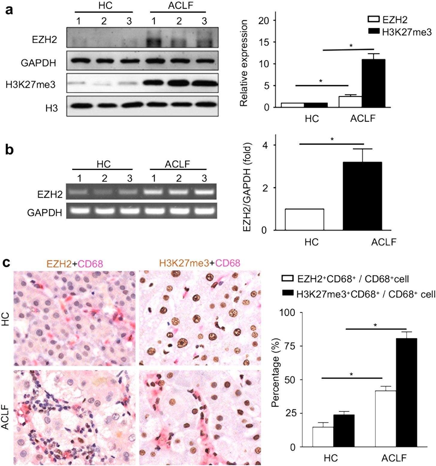 Enhancer of zeste homolog 2-catalysed H3K27 trimethylation plays a key role  in acute-on-chronic liver failure via TNF-mediated pathway | Cell Death &  Disease