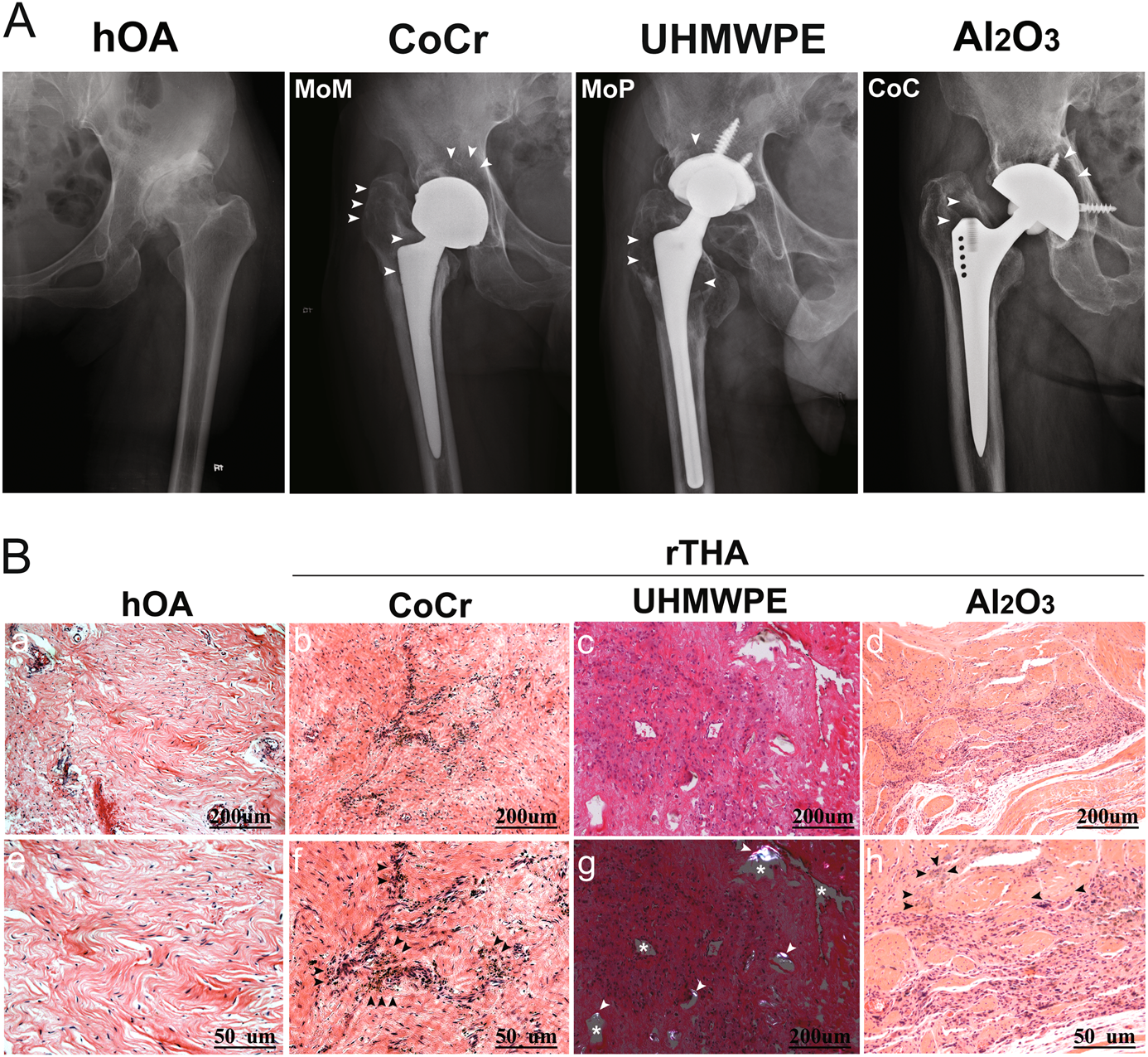 Fig. 1: Imaging and histomorphological manifestations of prosthesis loosening with different frictional interfaces.
