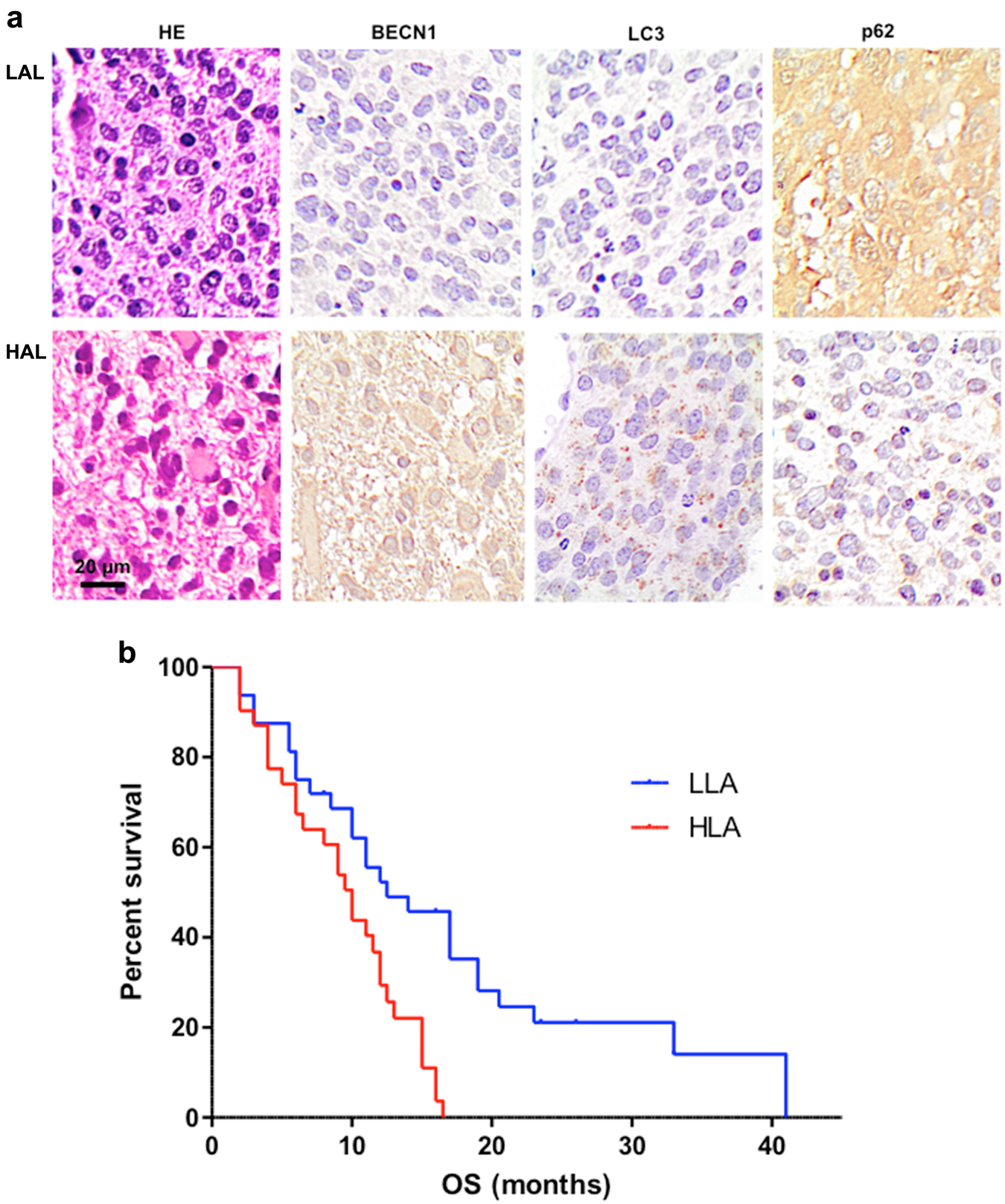 Fig. 1: Ex vivo analysis of autophagic markers in GBM samples and patients’ overall survival.