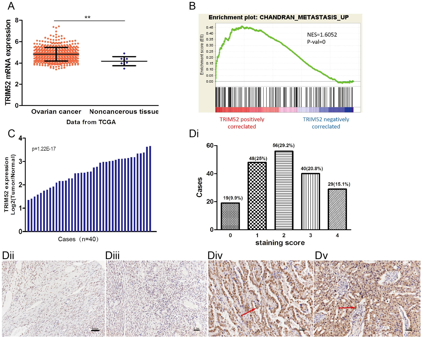 Fig. 1: TRIM52 expression in ovarian cancer.