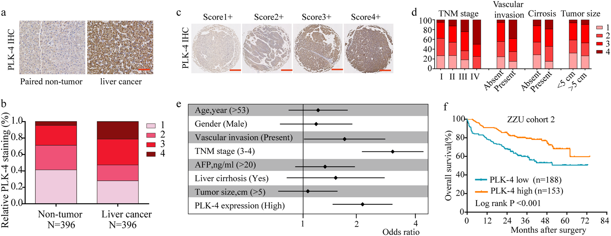 Fig. 4: PLK-4 expression is positive associated with poor prognosis of HCC.