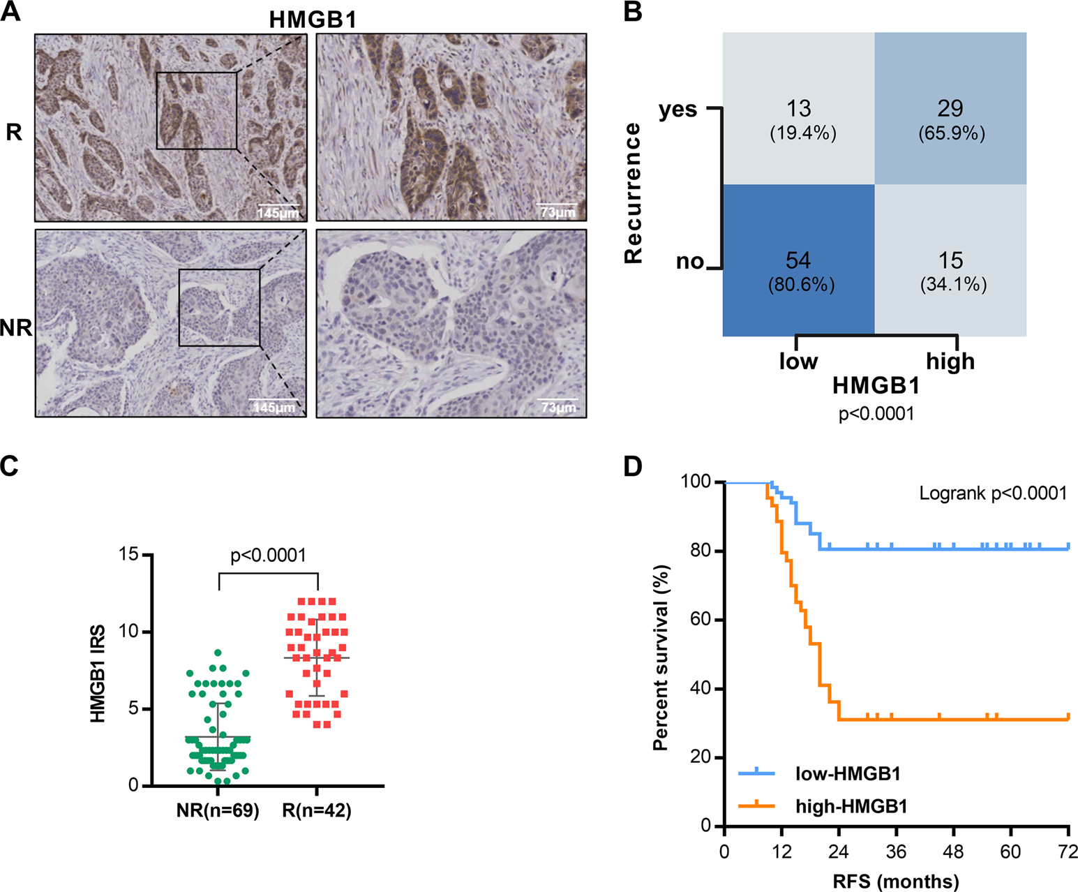 Fig. 1: High HMGB1 expression associates with recurrence and poor outcome after postoperative radiotherapy in locally advanced resected ESCC.