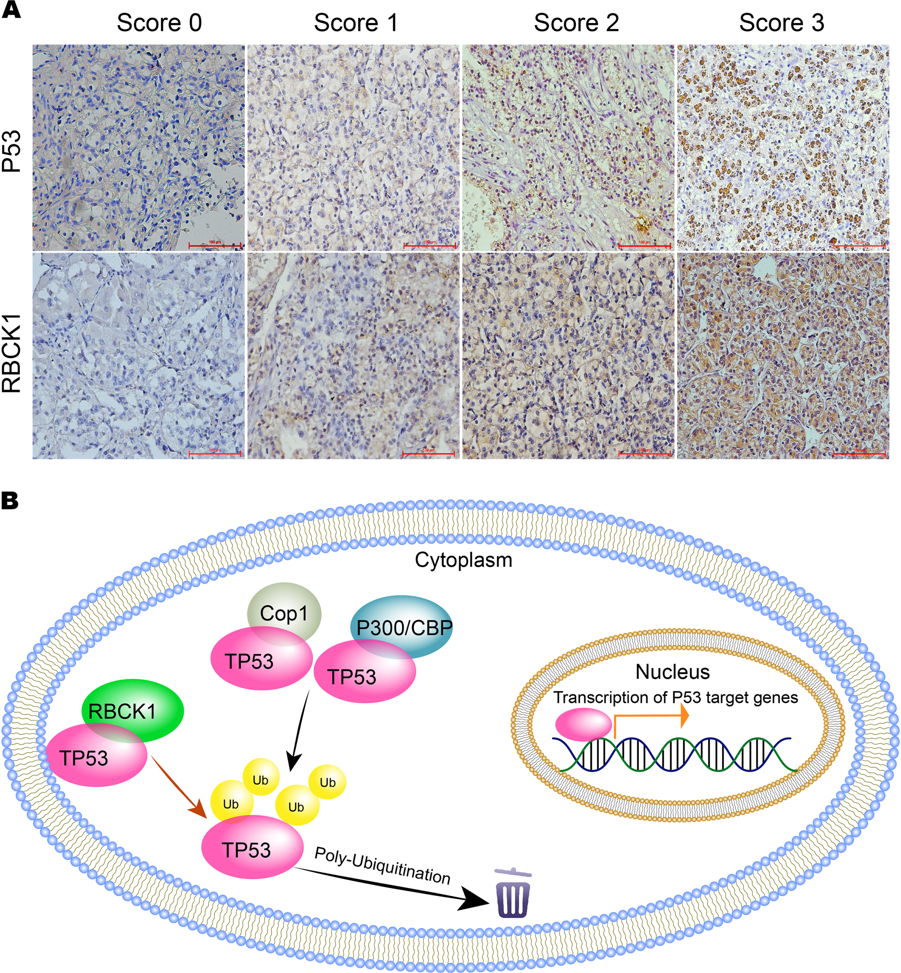 Fig. 9: Immunohistochemistry examination of RBCK1 and p53 expression in RCC tissues.