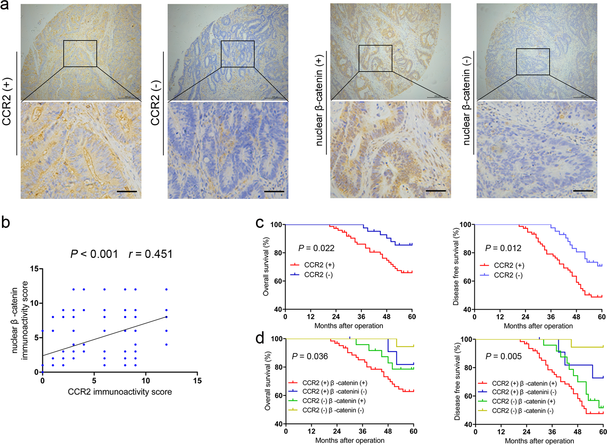 Fig. 7: Clinical significance of CCR2 and nuclear β-catenin expression in CRC patients.