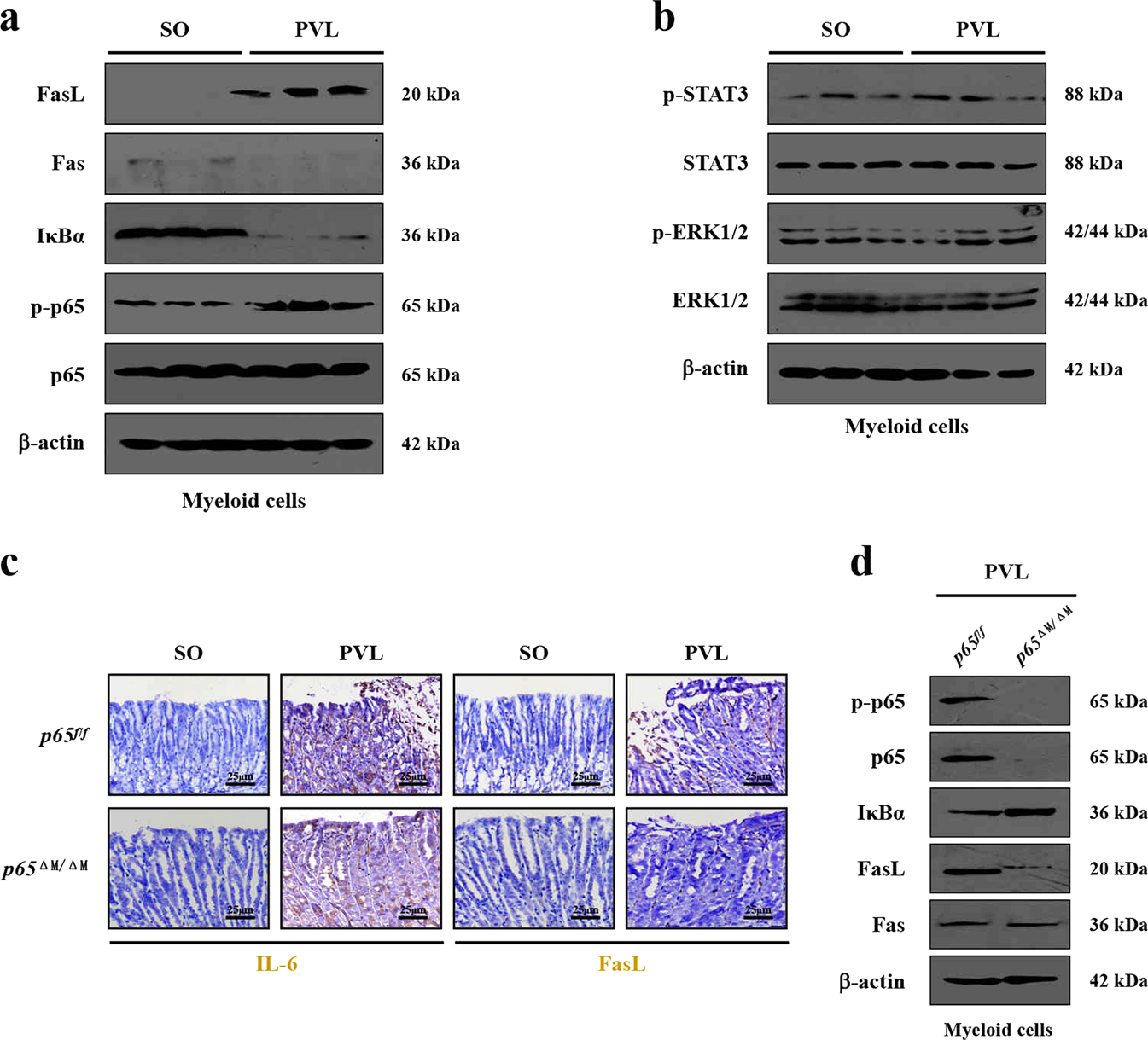 Fig. 4: IL-6 upregulated FasL levels via NF-κBp65 in myeloid cells in PHG.