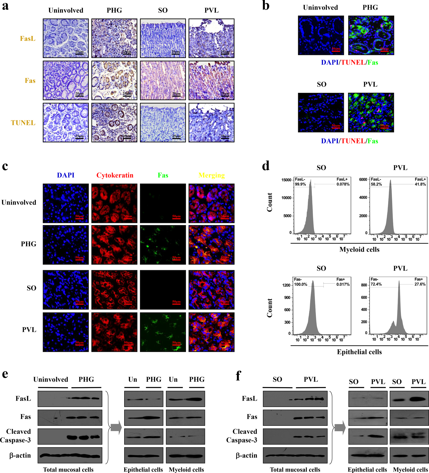 Fig. 5: IL-6-driven FasL contributed to epithelial apoptosis via Fas in PHG.