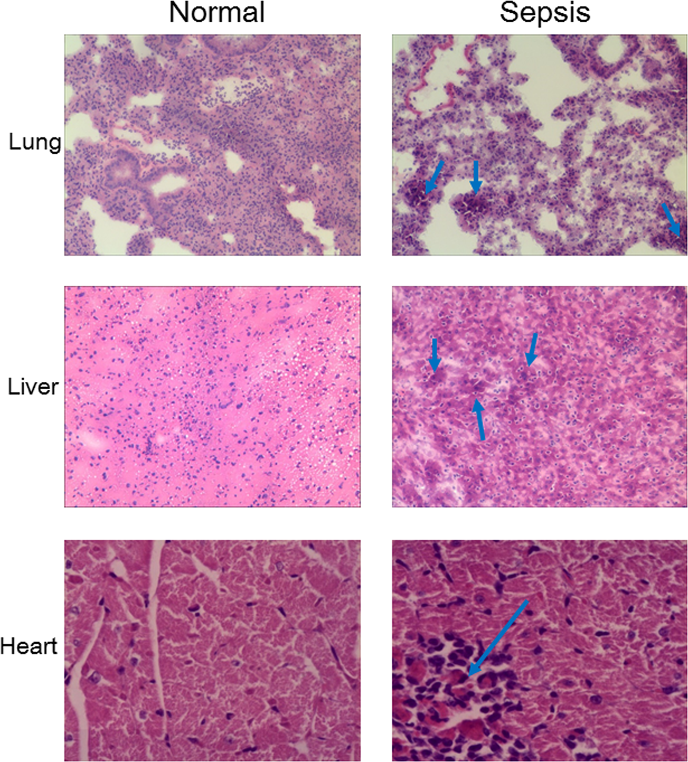 Fig. 4: Sepsis-induced delayed apoptosis and recruitment of neutrophils into tissues lead to multiple organ dysfunction syndrome.