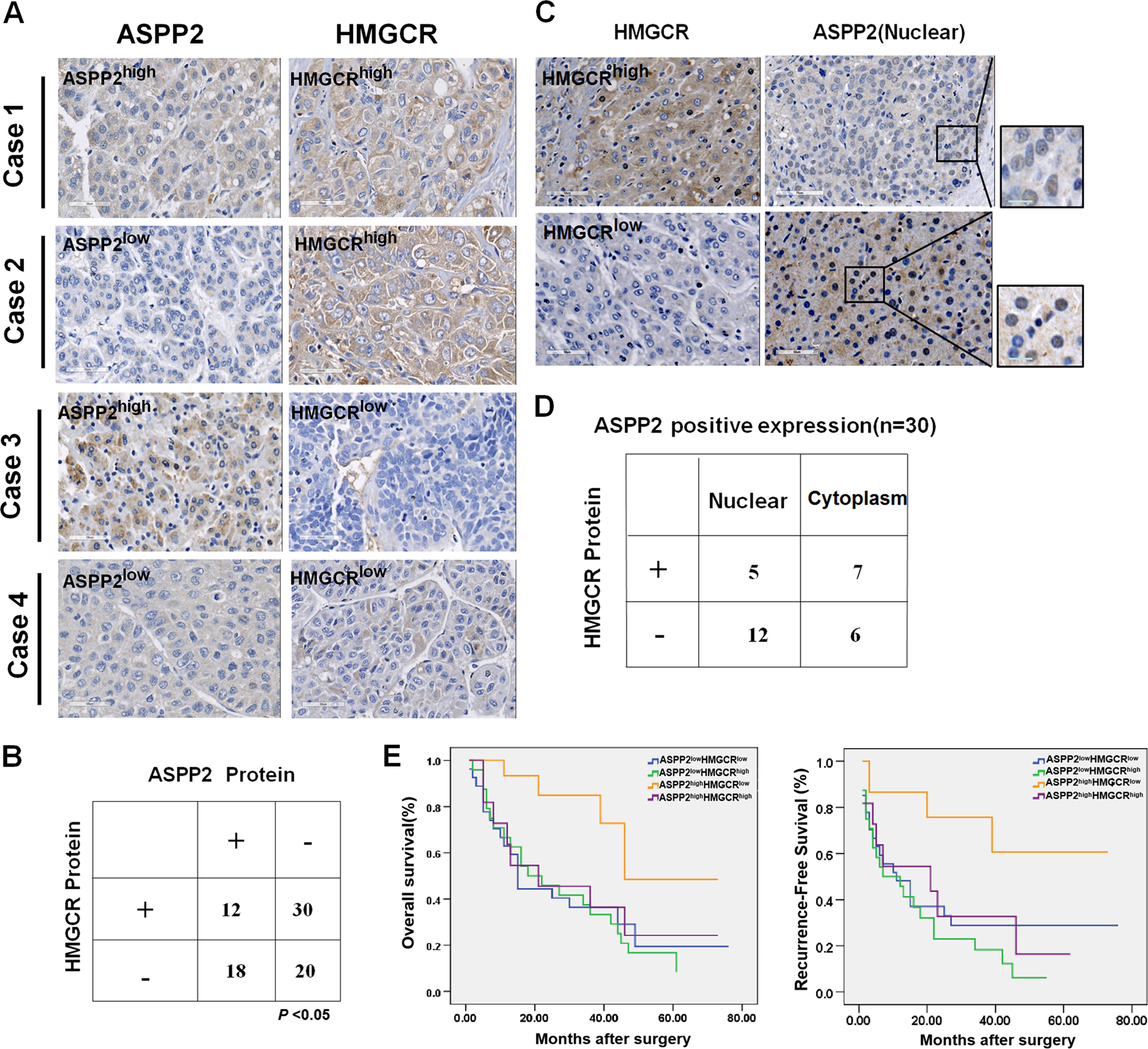 Fig. 5: Expression of ASPP2 correlates negatively with HMGCR in surgical specimens of HCC.
