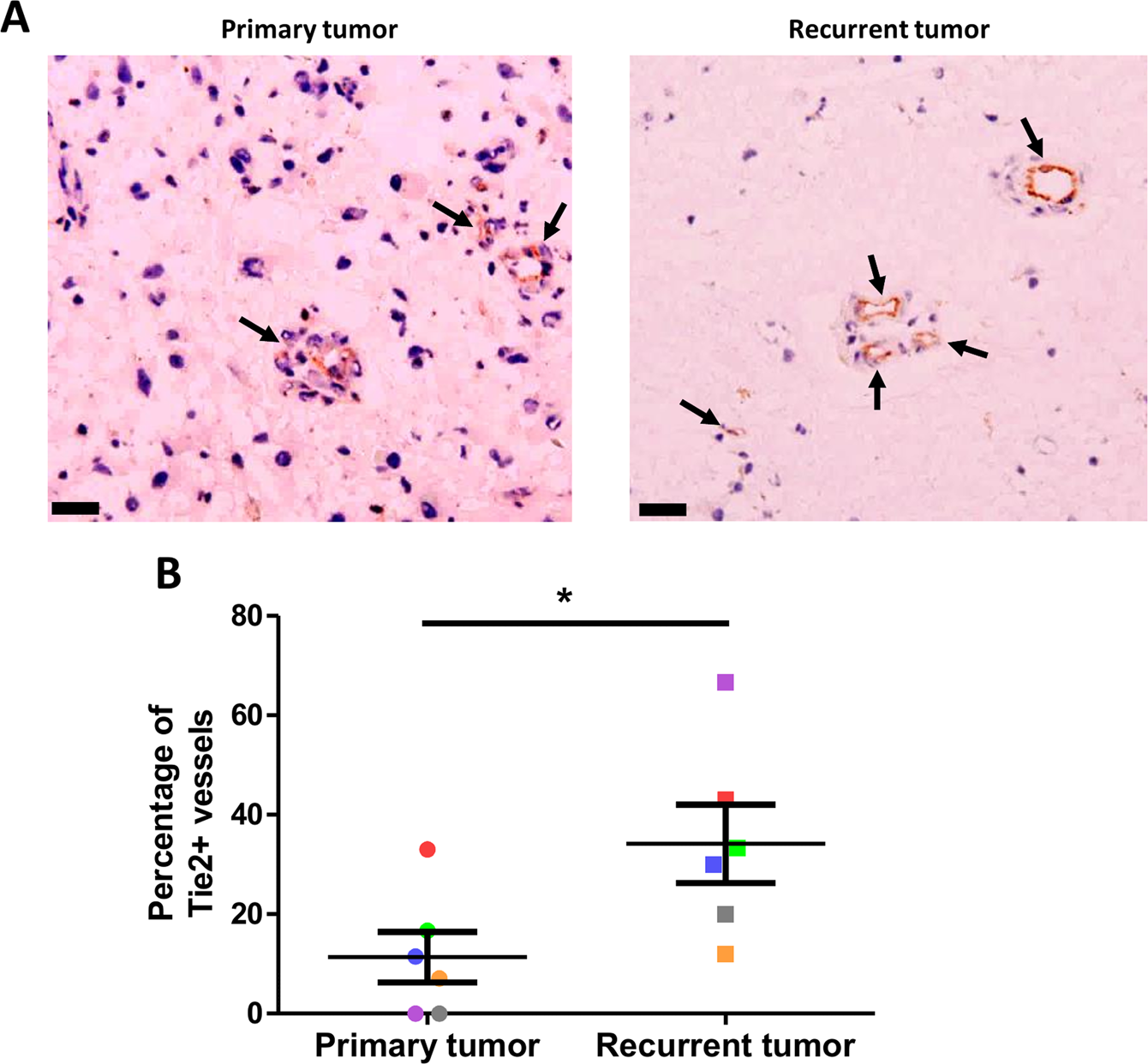 Fig. 6: Increase in the percentage of Tie2+ vessels in recurrent GBM.