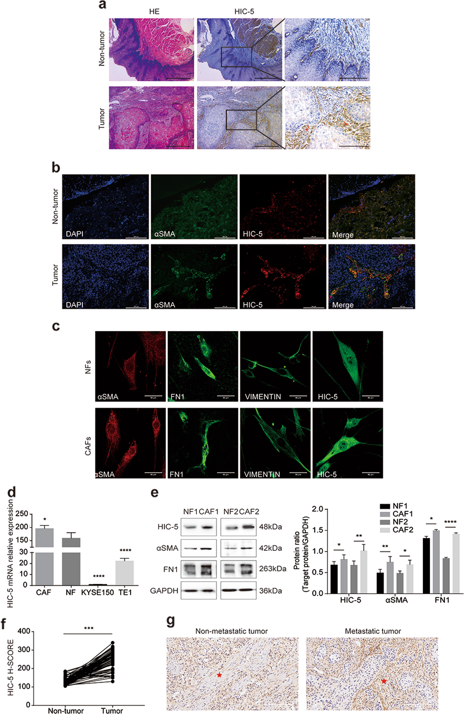 Fig. 1: HIC-5 is highly expressed in CAFs from human ESCC tumor stroma.