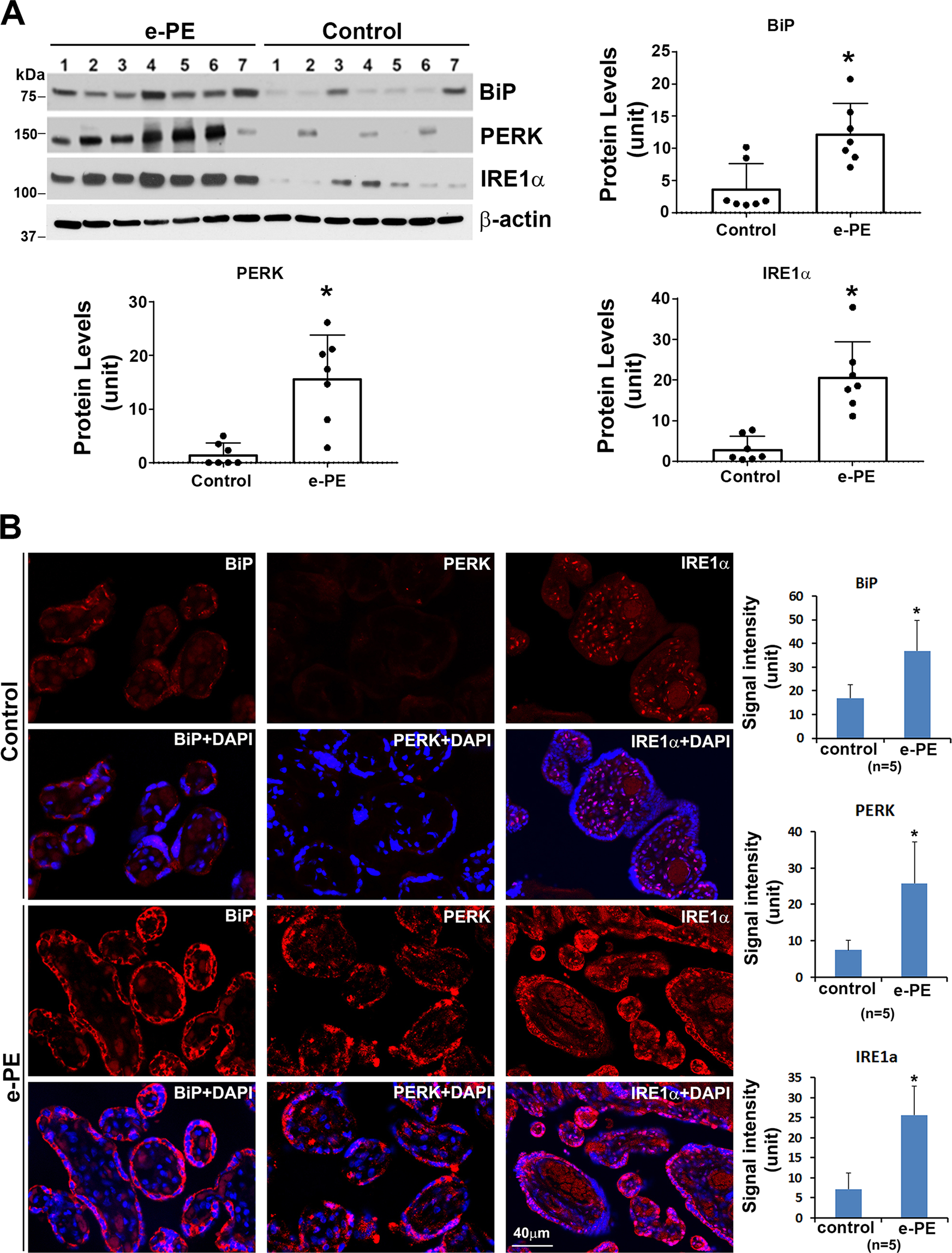 Fig. 6: Expression and distribution of BiP, PERK, and IRE1α in e-PE placentas.